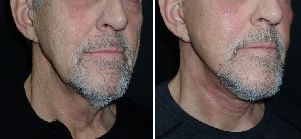 Facelifts for Men in Richmond, VA