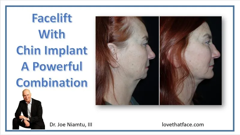 before and after photo of face lift