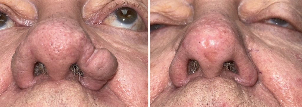 Rhinophyma Surgery