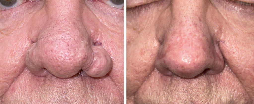Rhinophyma Surgery