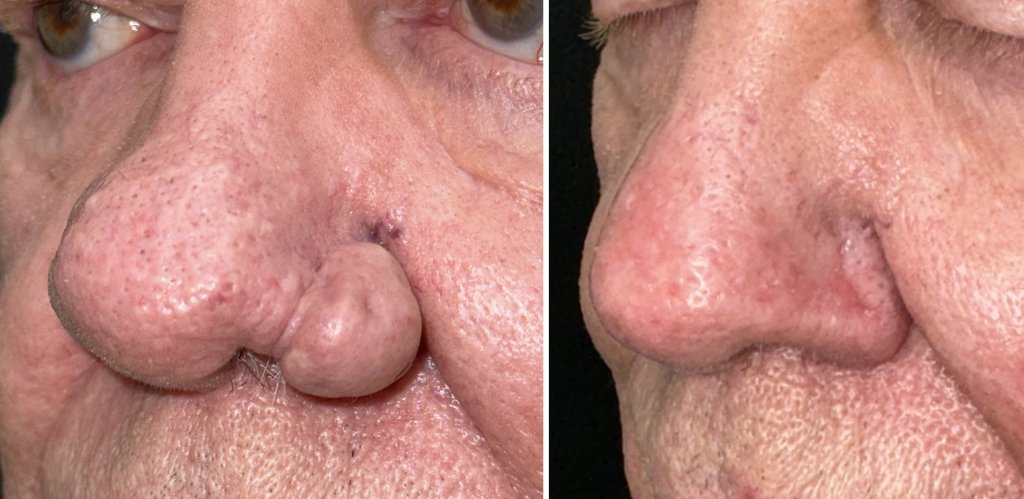Rhinophyma Surgery