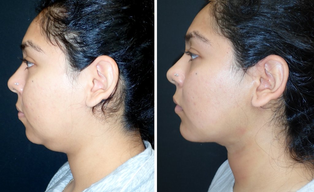 Submentoplasty