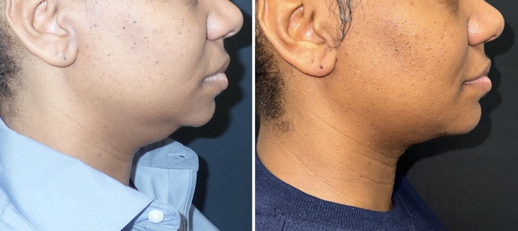 Submentoplasty