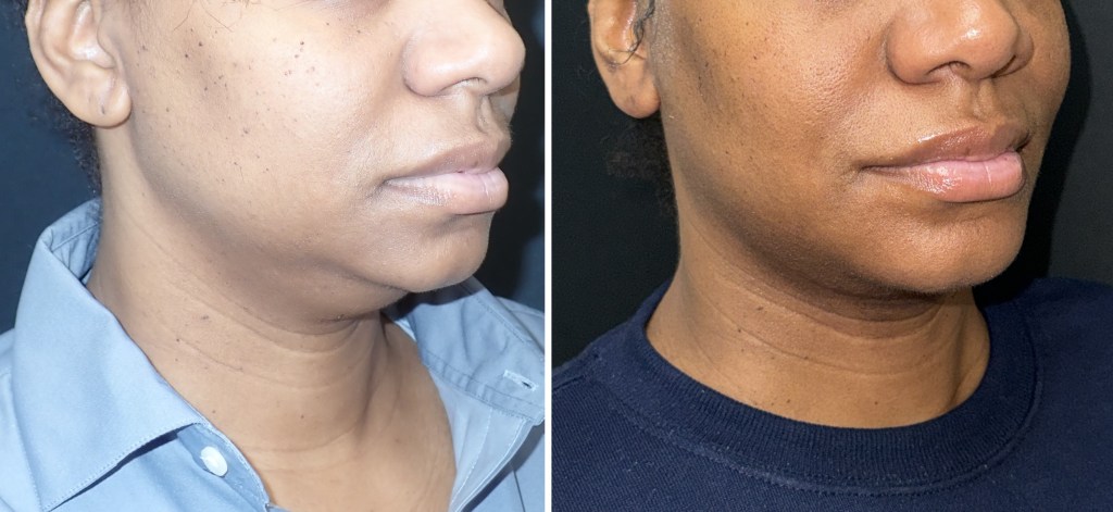 Submentoplasty
