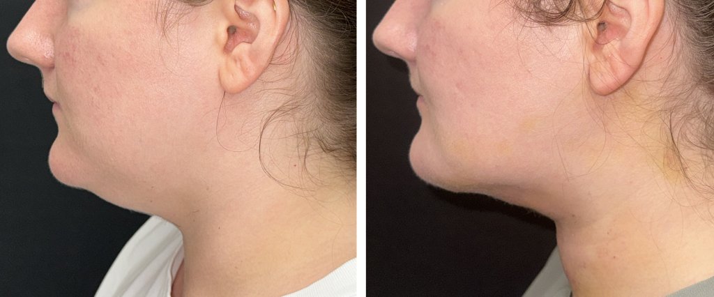 Submentoplasty in Richmond