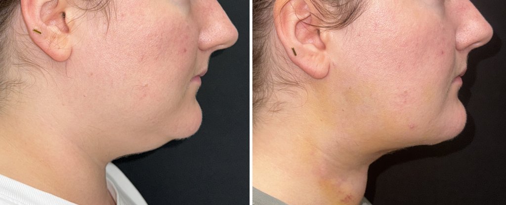 Submentoplasty in Richmond