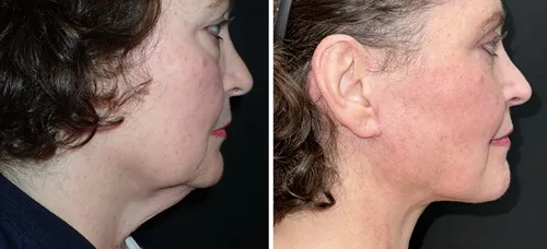 Facelift & Neck Lift