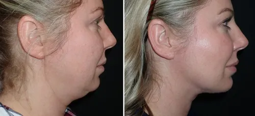 Facelift & Neck Lift