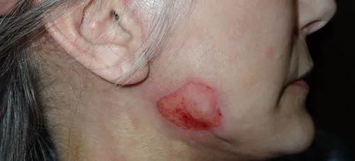 Facelift & Neck Lift