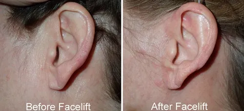 Facelift & Neck Lift