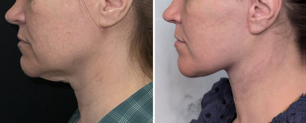 before and after chin surgery