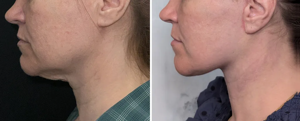 before and after chin surgery