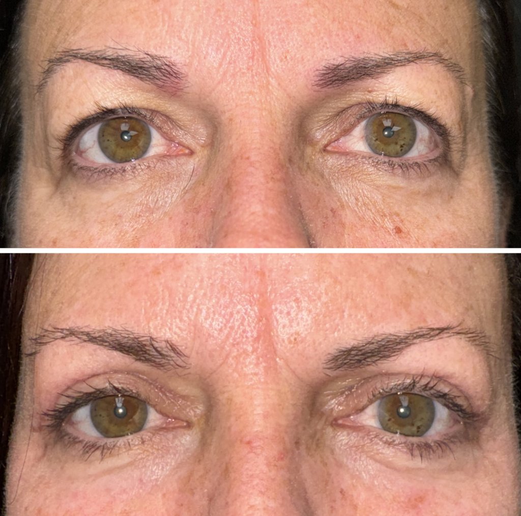 before and after eyelid surgery