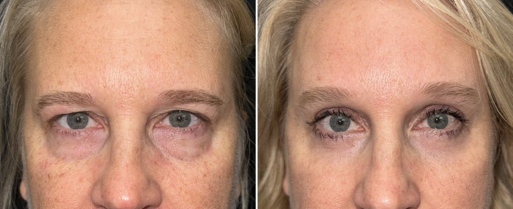 Brow & Forehead Surgery in Richmond, VA