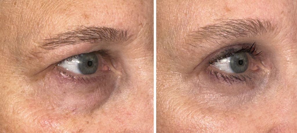 Brow & Forehead Surgery in Richmond, VA