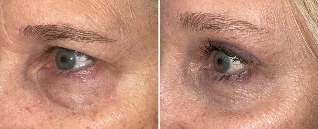Brow & Forehead Surgery in Richmond, VA
