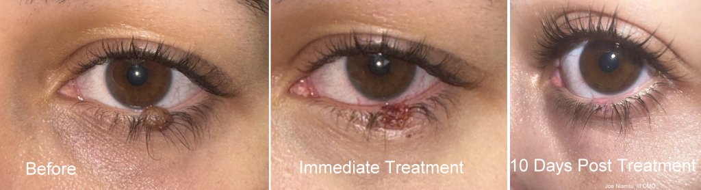 Mole Removal