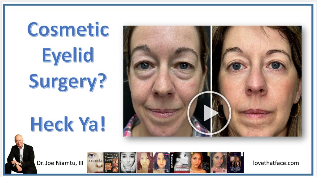 before and after eyelid surgery