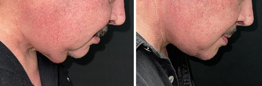Facelifts for Men in Richmond, VA