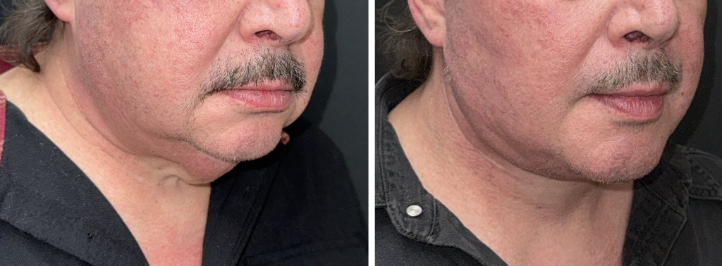 Facelifts for Men in Richmond, VA