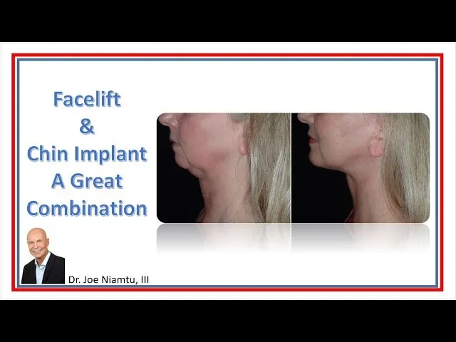 Facelift And Chin Implant: A Great Combination Video Thumbnail