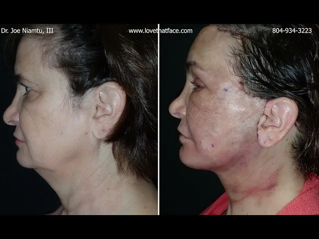 Deep Plane Face And Neck Lift: The Next Day Video Thumbnail
