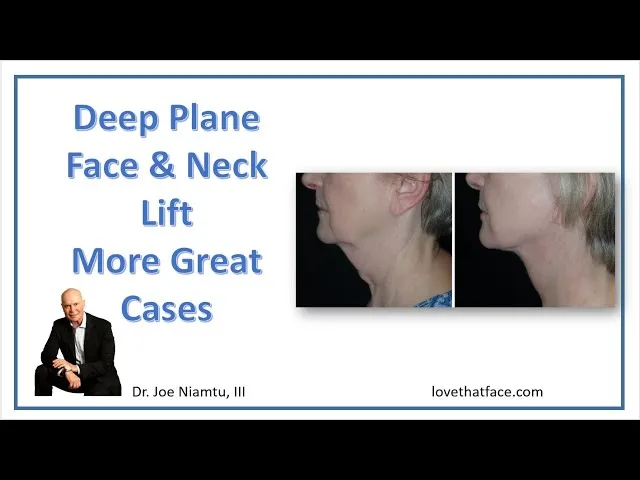 Deep Plane Facelift: More Great Cases Video Thumbnail