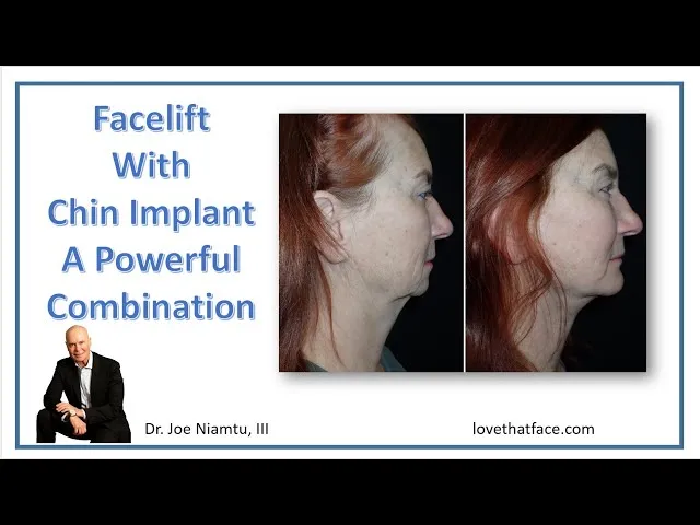 Facelift With Chin Implant: A Powerful Combination Video Thumbnail