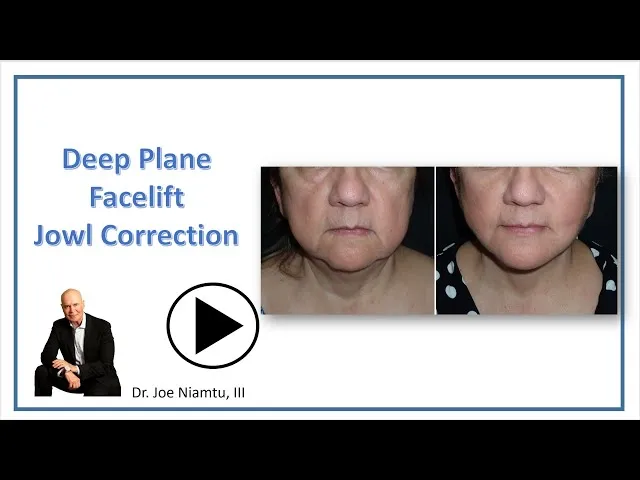 Deep Plane Facelift For Jowl Improvement Video Thumbnail