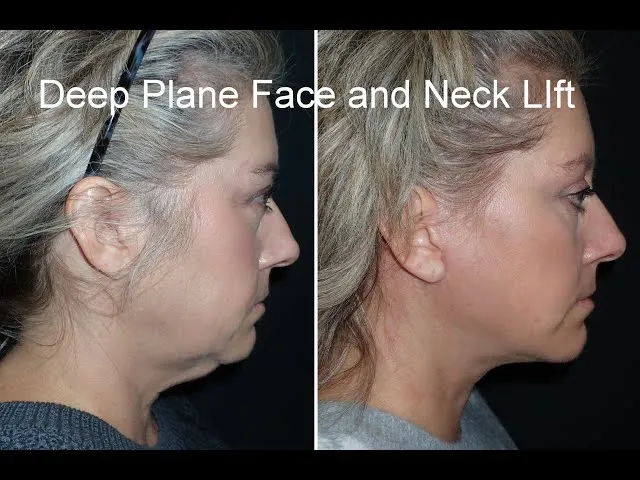 Deep Plane Face And Neck Lift: Great Patient, Awesome Result Video Thumbnail