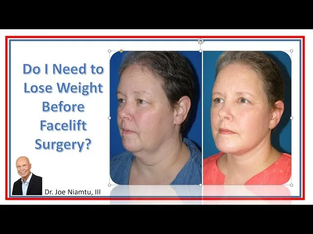Do I Need To Lose Weight Before Facelift Surgery? Video Thumbnail