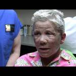 Dr. Niamtu Patient 24 Hours After Facelift, Eyelids And CO2 Laser Video Thumbnail