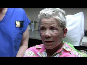 Dr. Niamtu Patient 24 Hours After Facelift, Eyelids And CO2 Laser Video Thumbnail