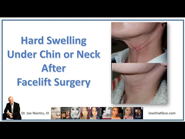 Hard Swelling Under The Chin And Neck After Facelift Surgery Video Thumbnail