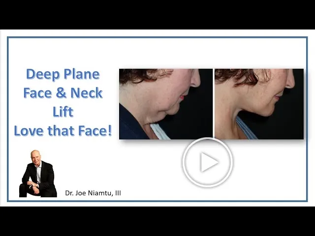 Deep Plane Facelift With Deep Plane Neck Lift And Submandibular Gland Reduction Video Thumbnail
