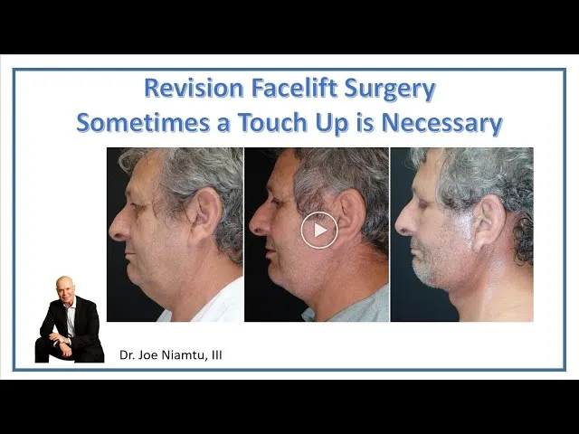 Revision Facelift Surgery: Sometimes You Need A Touch Up Video Thumbnail