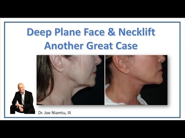 Deep Plane Face & Neck Lift Gets It Done Video Thumbnail
