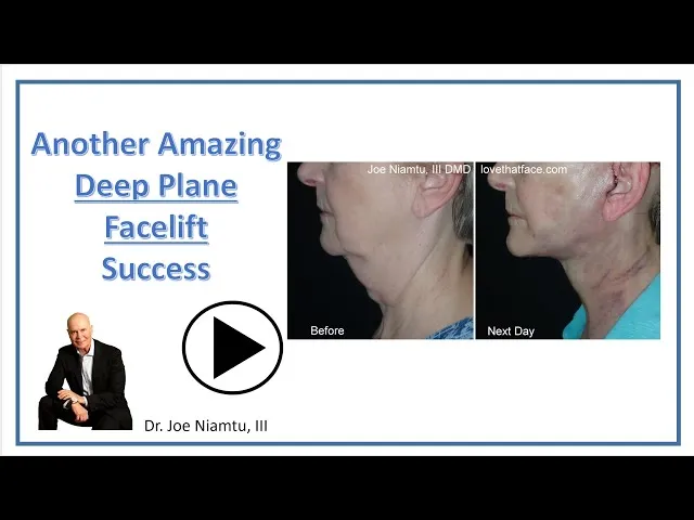 Deep Plane Facelift: The Day After And The Joy Of The Surgeon And Patient Video Thumbnail