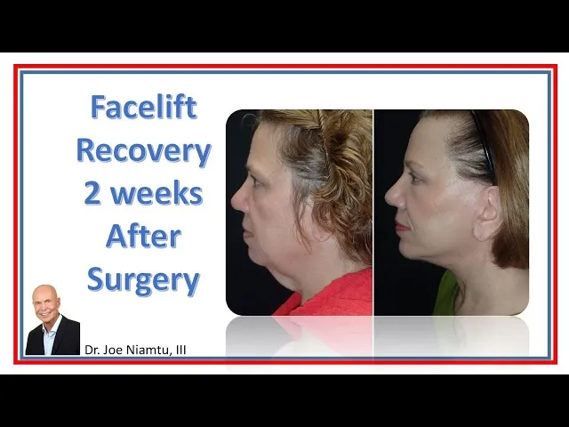 Facelift Recovery After 2 Weeks Video Thumbnail