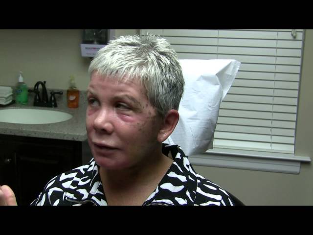 Cosmetic Surgery Recovery By Dr. Joe Niamtu, III: 6 Days Post Op Facelift, Laser, Eyelids Video Thumbnail