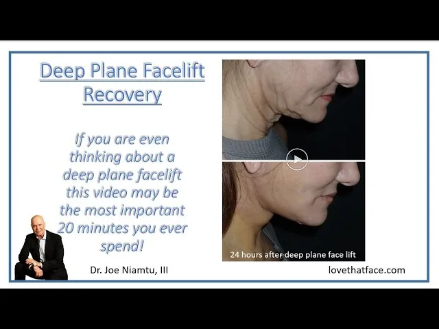 Deep Plane Facelift Recovery: Watch This Video If You Are Even Thinking About Having A Facelift Video Thumbnail