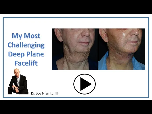 My Most Challenging Deep Plane Facelift Video Thumbnail